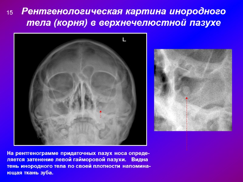 Рентгенологическая картина инородного тела (корня) в верхнечелюстной пазухе На рентгенограмме придаточных пазух носа опреде-